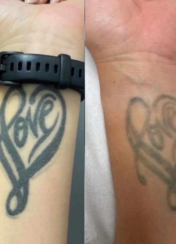 Laser Skin Treatments