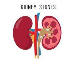 Homeopathy for Kidney Stones