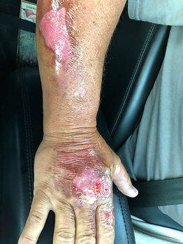 Day 1 Dr diagnosed 3rd degree burn.jpeg