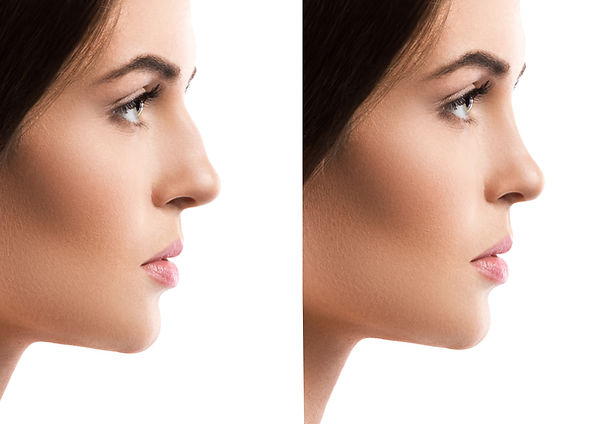 comparison-female-face-after-rhinoplasty-white-background.jpg