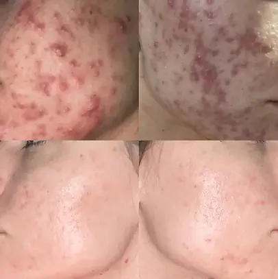 inflamed-cystic-acne-transformation