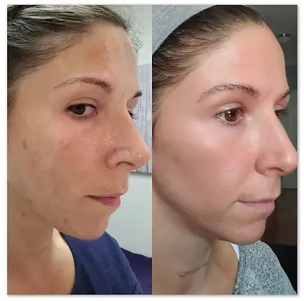 pigmentation-before-and-after
