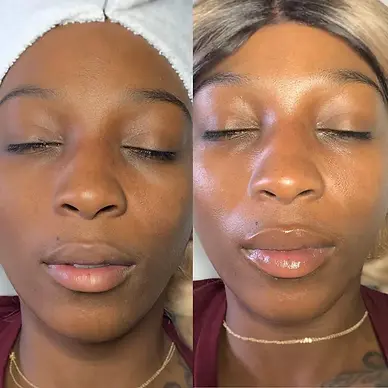 pigmentation-post-treatment-glow