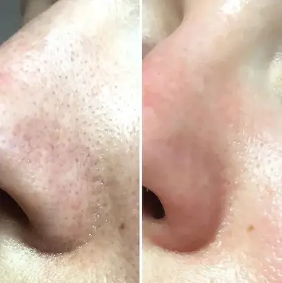 pore-size-before-and-after