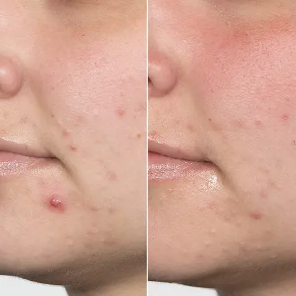 before-and-after-photo-acne-skin