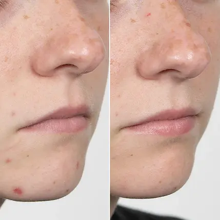 chin- acne-before-and-after-acne-skin