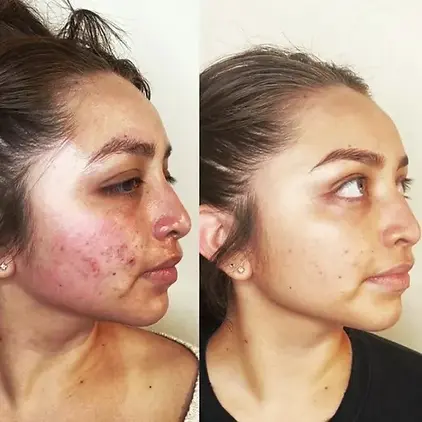 inflamed-acne-before-and-after