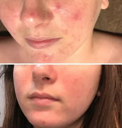 redness-sensitive-skin-before-and-after