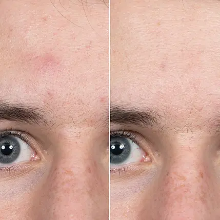 forehead-before-and-after-acne