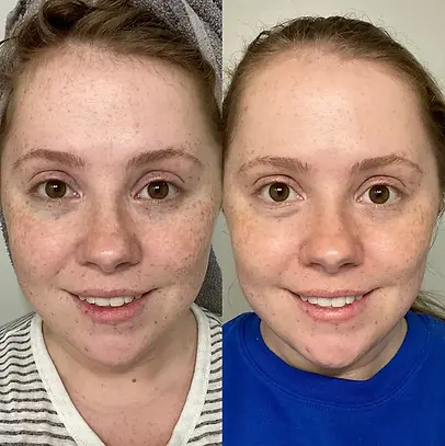 pigmentation-reduction-skin-glow