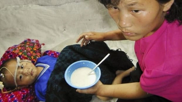 3-year-old Song Chul being fed vitamins supplied by United Nations.