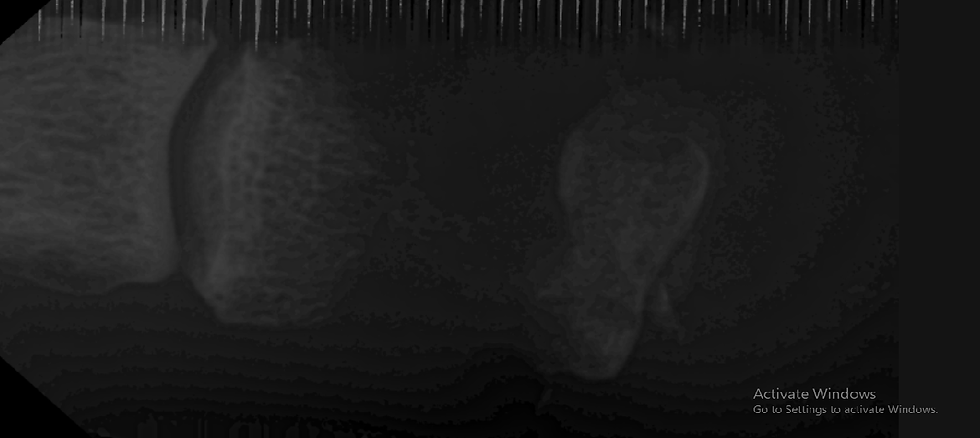 Image 4 X ray AP view of 2nd toe of same patient.