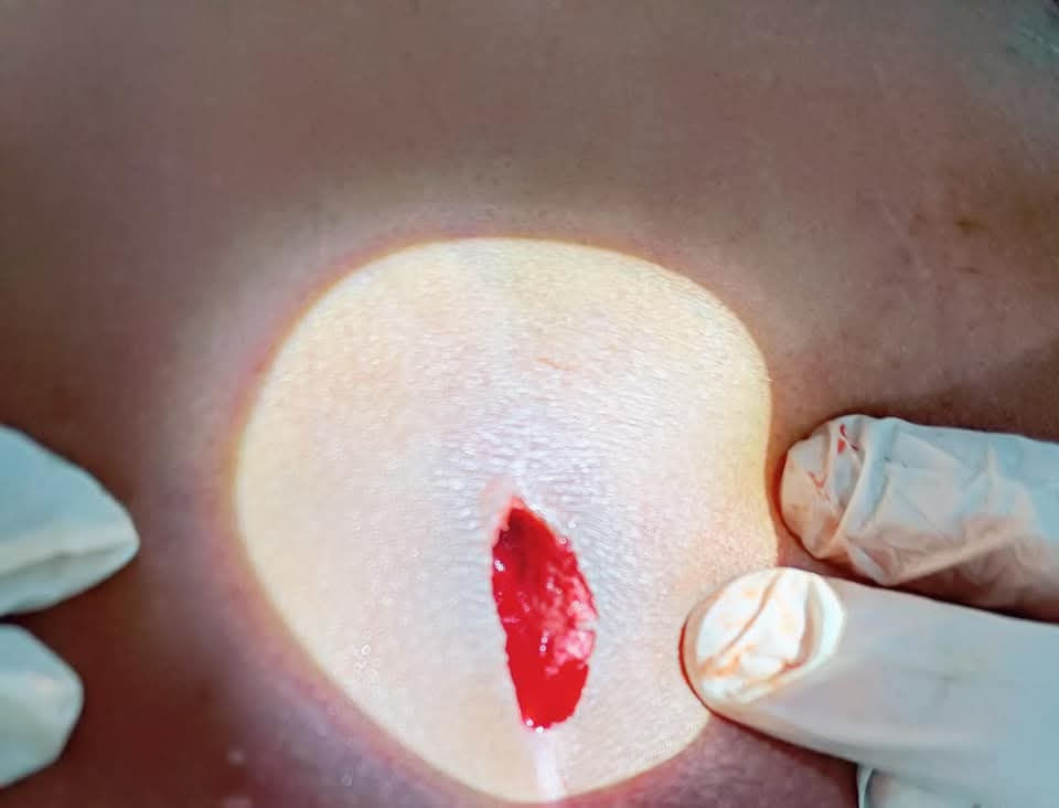 Image 5. Excision of pilonidal sinus.