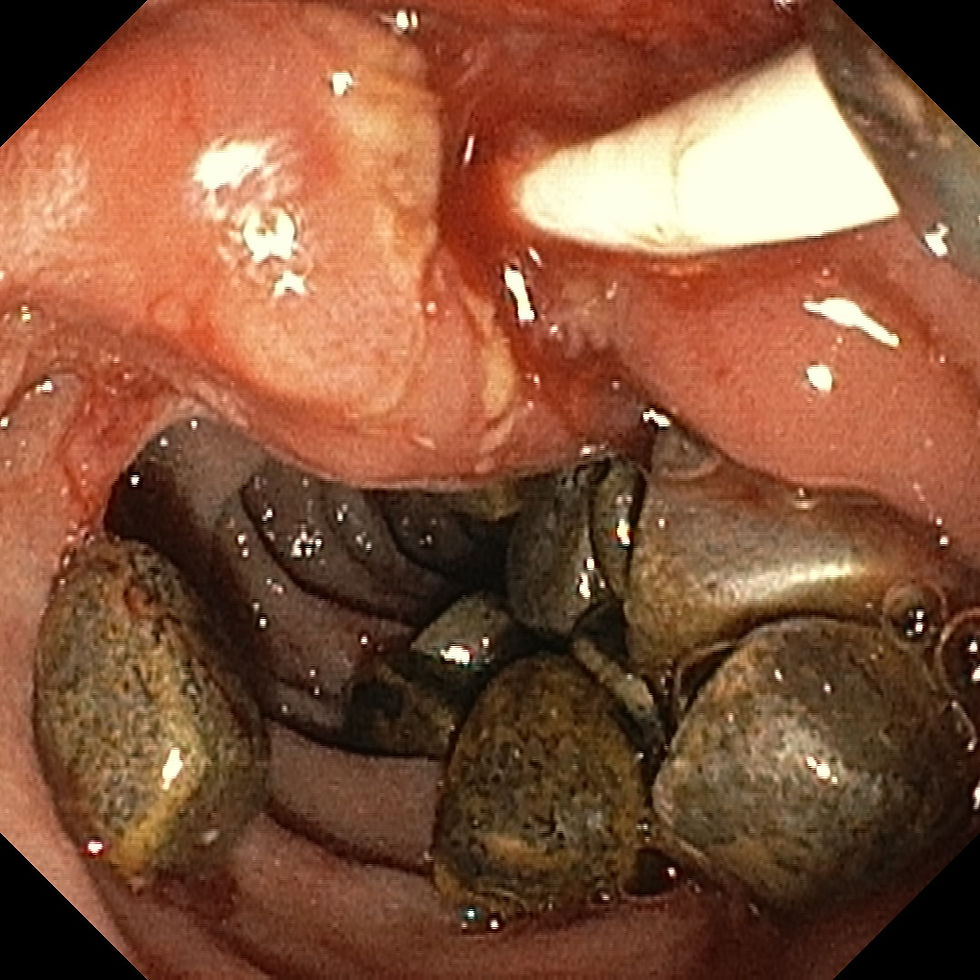 Image 7. Endoscopic image showing multiple common bile duct (CBD) stones being removed during balloon sweeps. Image credit: Dr. Naveen Kumar.