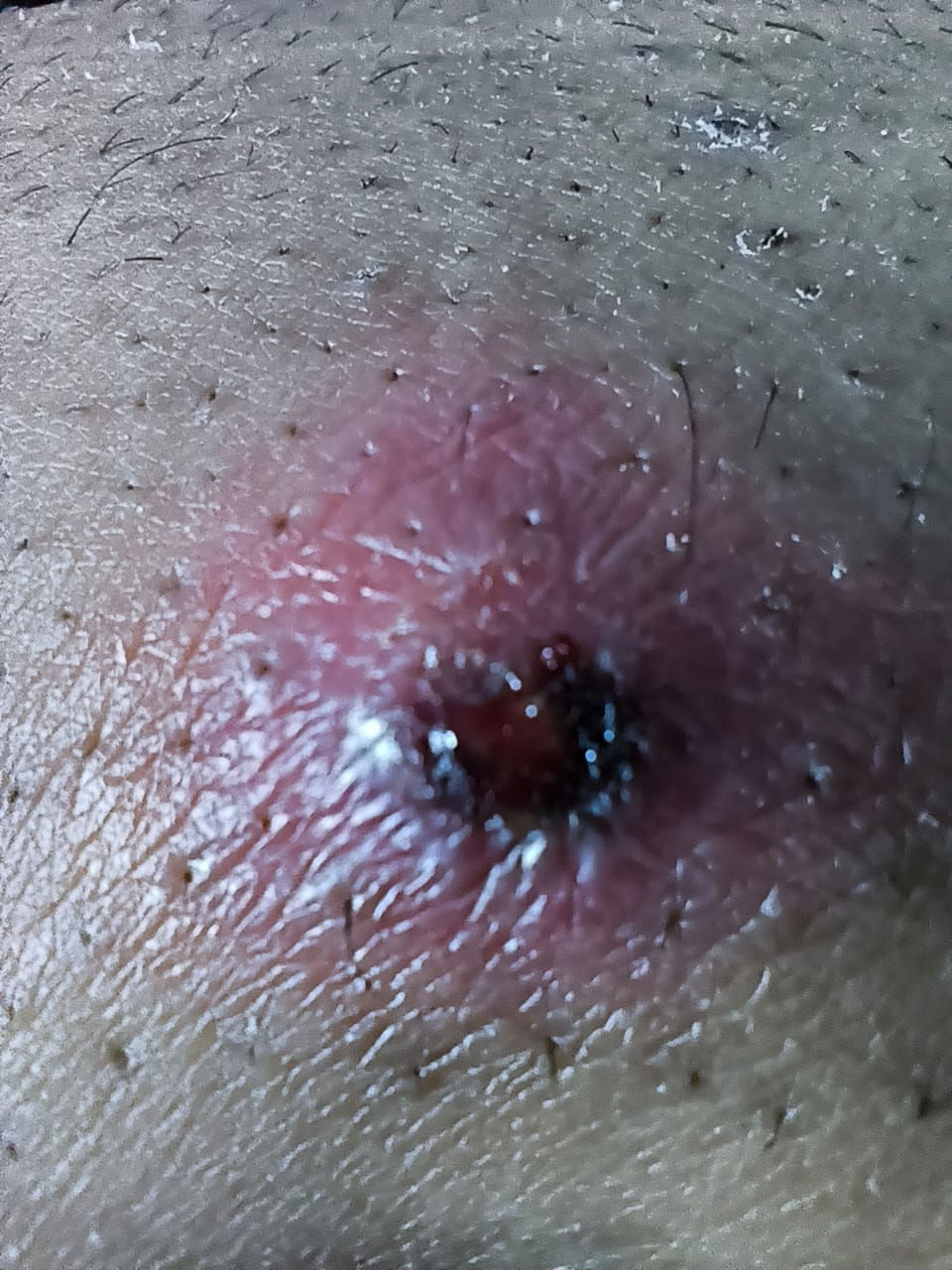 Image 1. Showing Eschar in patient with Scrub typhus.