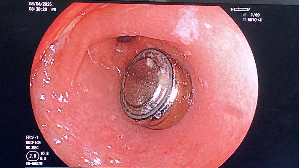 Endoscopic image showing a button battery lodged in the esophagus of a child. The metallic battery is embedded in the mucosa with signs of surrounding tissue inflammation.