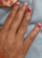 Image 8. Showing cystic swelling over 4th finger right hand, Anterior view.