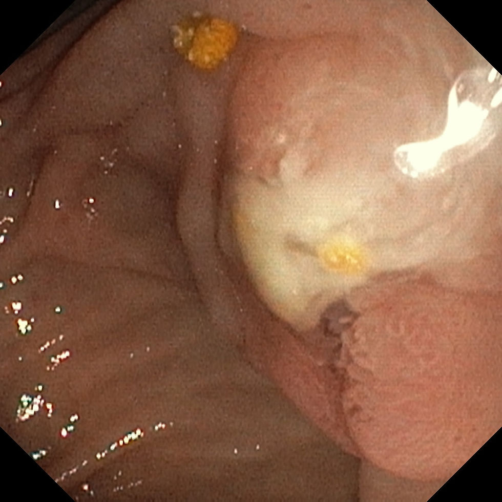 Image 9. Endoscopic image showing pus discharge from the papilla in a patient with severe cholangitis. Image credit: Dr. Naveen Kumar.
