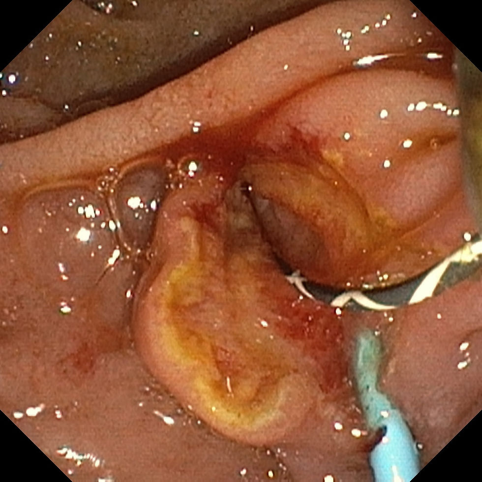 Image 4. Endoscopic view showing sphincterotomy performed prior to stone extraction. Image credit: Dr. Naveen Kumar.
