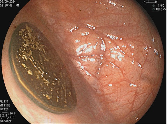 चित्र 6: 15 दिन पहले पेट में गए सिक्के का एंडोस्कोपिक दृश्य। (चित्र साभार: डॉ. नवीन कुमार)