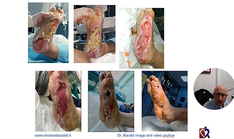 BARALDI PIEDE DIABETICO Torino 28-29 novembre 2025 solo micrograft - PowerPoint 08_12_2025