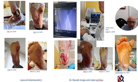 BARALDI PIEDE DIABETICO Torino 28-29 novembre 2025 solo micrograft - PowerPoint 08_12_2025