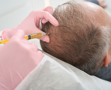 Hair Restoration being administered at Med Spa