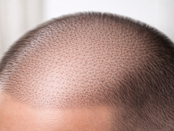 Hair Density Simulation in Alberta: A Non-Surgical Option for Thinning Hair