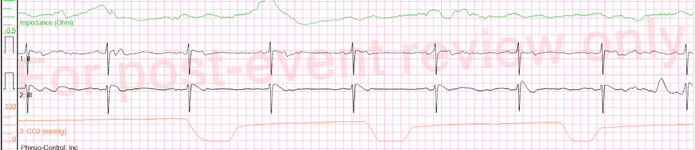 Transcutaneous Pacing: Part 2