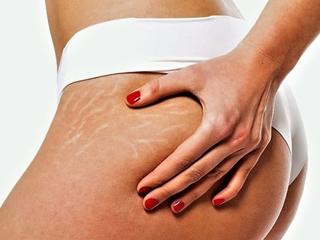 Entendiendo las Estrías: Todo lo que Necesitas Saber para Cuidar tu Piel