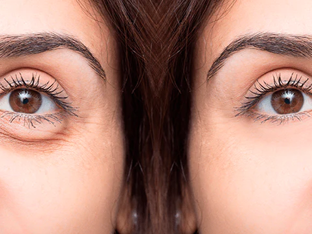 ¿Cómo eliminar y prevenir las ojeras? ¡Te contamos todo lo que necesitas saber!