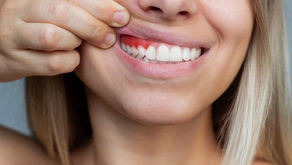 Encías retraídas, más allá de la estética dental