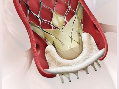 It's Topic Tuesday!- An Alternative to Redo Surgery: Valve-in-Valve TAVR