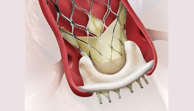 It's Topic Tuesday!- An Alternative to Redo Surgery: Valve-in-Valve TAVR