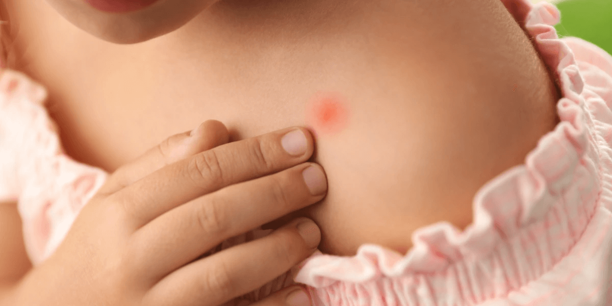 A picture of a child with a painful fire ant sting on the shoulder