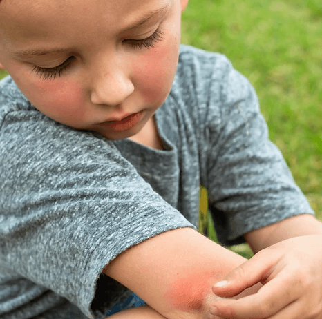 Little boy looking at a mosquito bite on his elbow.webp