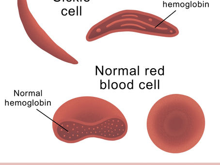 sickle cell