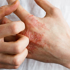 eczema, dermatitis.jpeg