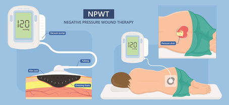 The Use of Negative Pressure Wound Therapy in Nursing Homes