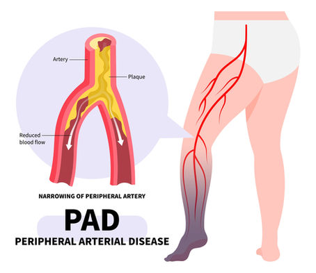 Healing Against the Current: A Guide to Wound Care with Peripheral Artery Disease