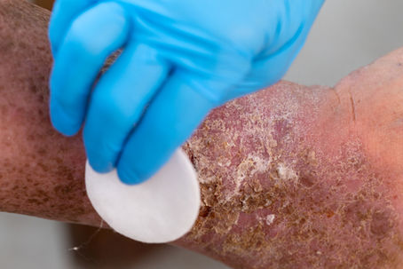 The Role of Infection Control Policies in Wound Care