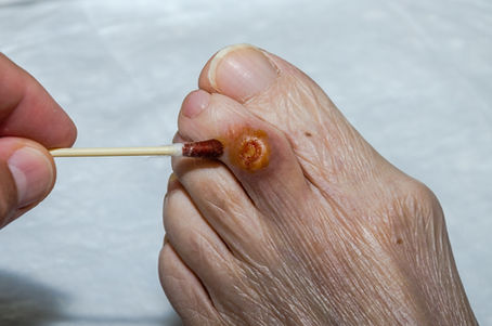 The Use of Antiseptics in Wound Care: What You Need to Know
