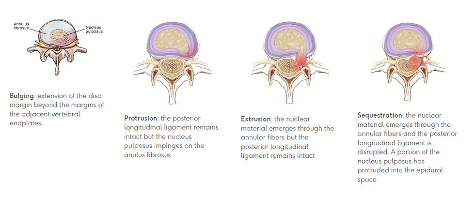 Types of disc herniations