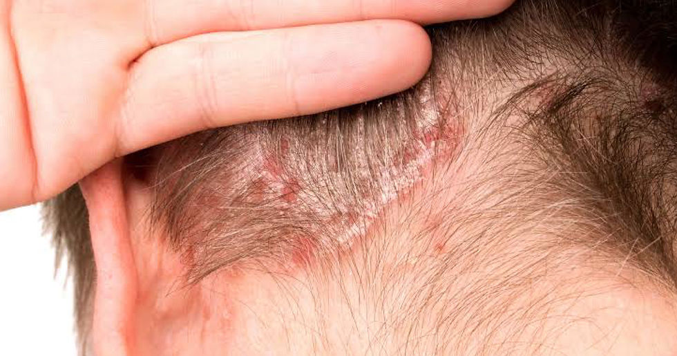 Scalp and Nail Psoriasis: The Two Hardest Places