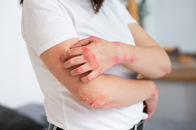 Psoriasis Treatment in Kota Kinabalu