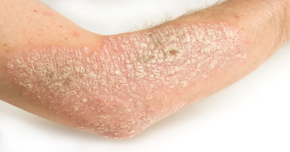 The Moving Baseline: Why Your Psoriasis Changes Over the Years