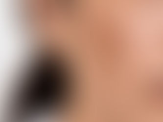 Melasma: Kesilapan Biasa & Kenapa Saya Tak Guna Laser