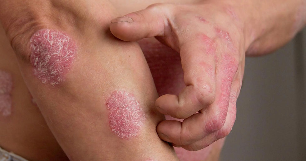 Psoriasis Treatment in Kota Kinabalu