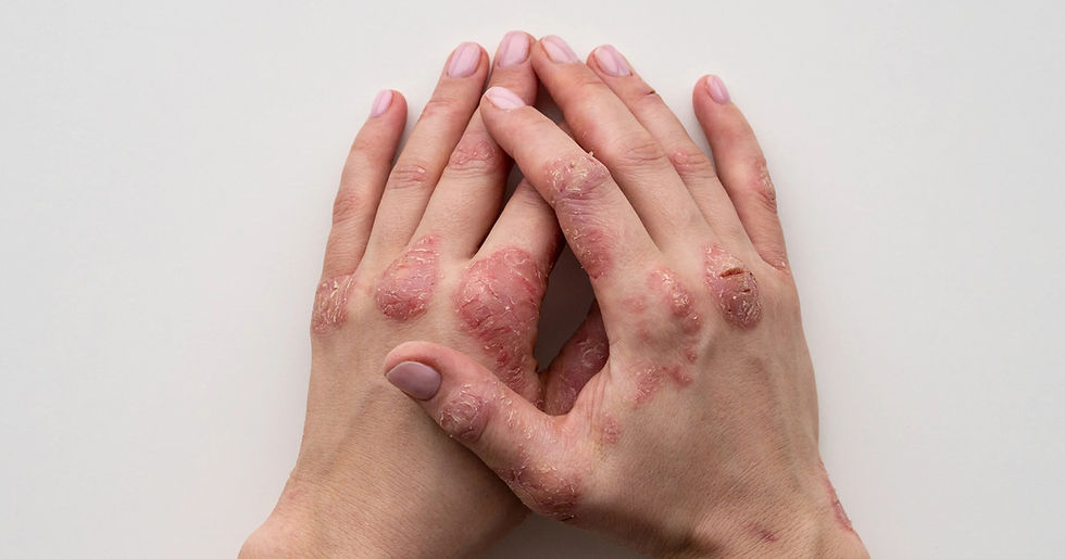 Is It Psoriasis, Eczema, or Fungal?