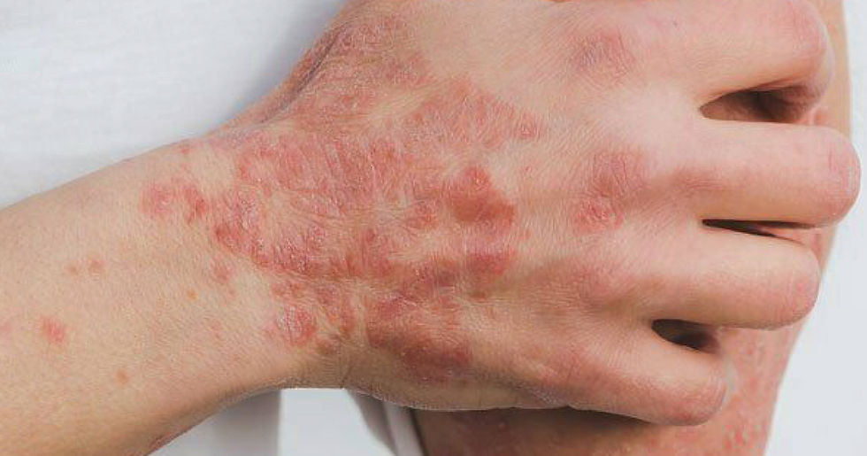 5 Eczema Mistakes You're Probably Making